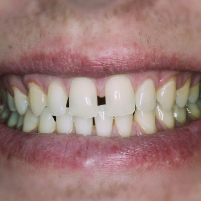 Dental Bonding - Smile 1 before